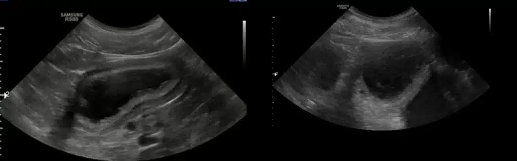 Sonografický nález - rohy maternice vyplnené tekutinou - pyometra
